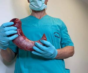 “Lamtumirë insulinës dhe të gjitha mjekimeve”/ Kirurgu shqiptar guxon shumë: Diabeti shërohet me operacion, ja fotot!. Njerëzit alarmohen: Ç’organ ke hequr more?!